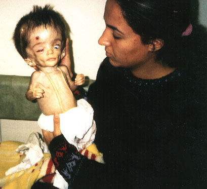 http://merryabla64.files.wordpress.com/2009/01/iraqi-child-victim-of-depleted-uranium.jpg?w=409&h=373